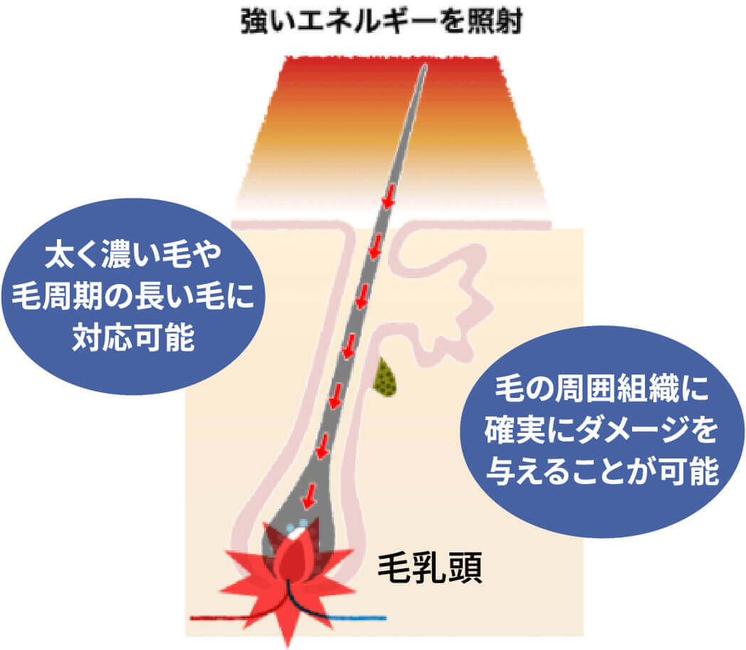 強いエネルギーを照射